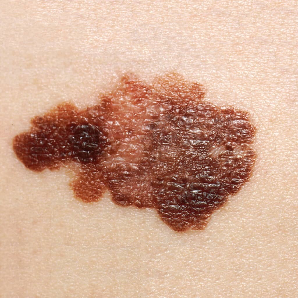 melanoma e tumori della pelle